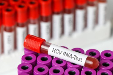 Kandaki anormallikleri araştırmak için HCV RNA Testi, laboratuvarda analiz etmek için kan örneği, test tüpünde kan