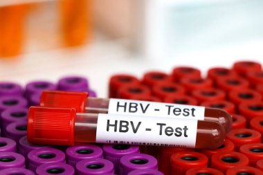 Kandaki anormallikleri araştırmak için HBV testi, laboratuvarda analiz edilecek kan örneği, test tüpündeki kan.
