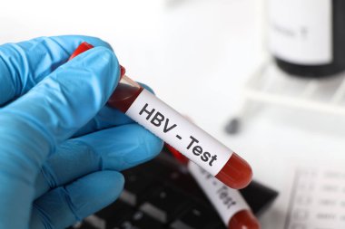 Kandaki anormallikleri araştırmak için HBV testi, laboratuvarda analiz edilecek kan örneği, test tüpündeki kan.