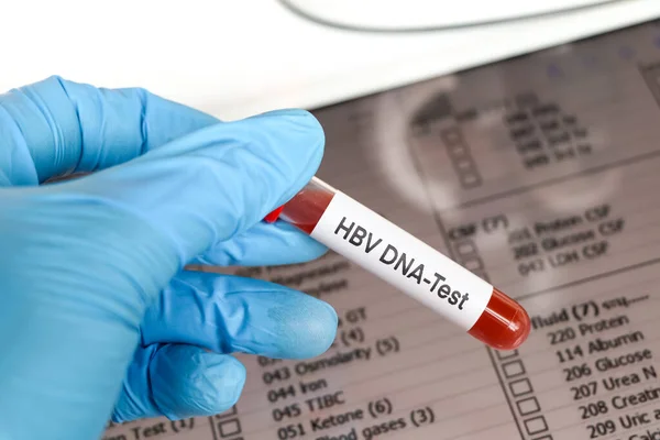 HBV DNA Test test to look for abnormalities from blood,  blood sample to analyze in the laboratory, blood in test tube