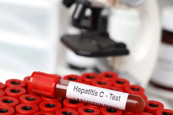 Hepatitis C Test test to look for abnormalities from blood,  blood sample to analyze in the laboratory, blood in test tube