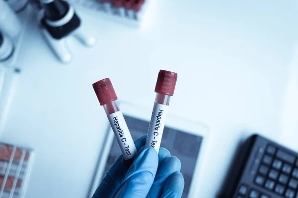 Hepatitis C Test test to look for abnormalities from blood,  blood sample to analyze in the laboratory, blood in test tube