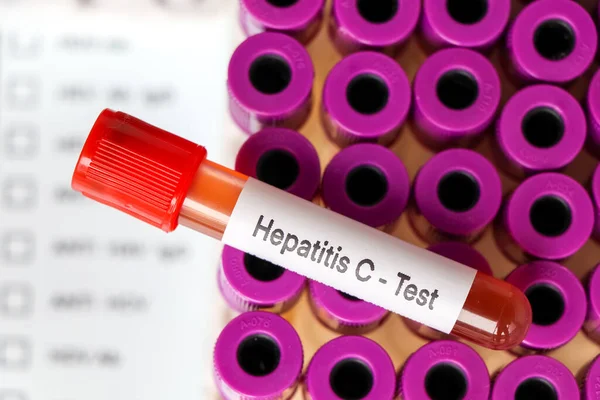Hepatitis Prueba Prueba Para Buscar Anormalidades Sangre Muestra Sangre Para — Foto de Stock
