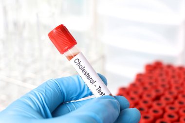 Kandaki anormallikleri araştırmak için kolesterol testi laboratuvarda analiz edilecek kan örneği, test tüpünde kan.