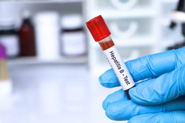 Kandaki anormallikleri bulmak için Hepatit B testi laboratuvarda analiz edilecek kan örneği, test tüpünde kan.
