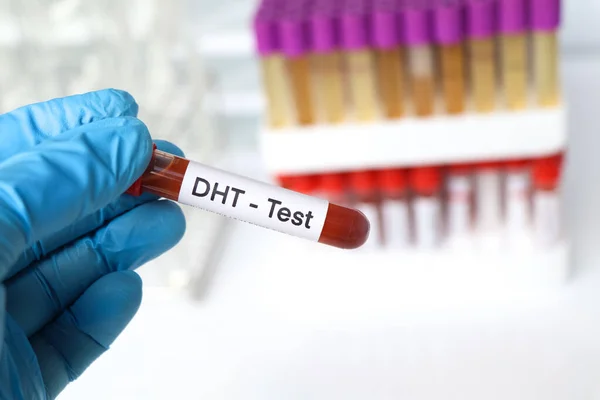 stock image DHT test to look for abnormalities from blood,  blood sample to analyze in the laboratory, blood in test tube