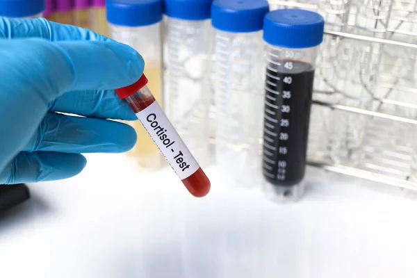 stock image Cortisol test to look for abnormalities from blood,  blood sample to analyze in the laboratory, blood in test tube