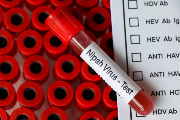 Nipah virus test to look for abnormalities from blood,  blood sample to analyze in the laboratory, blood in test
