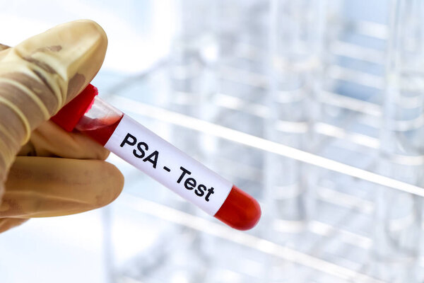PSA test to look for abnormalities from blood,  blood sample to analyze in the laboratory, blood in test tube