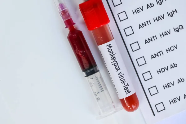 Monkeypox virus test to look for abnormalities from blood,  blood sample to analyze in the laboratory, blood in test