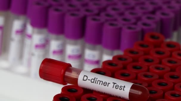 D二聚体检查从血液中寻找异常 血液样本在实验室分析 血液在试管中检测 — 图库视频影像