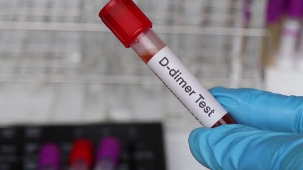 Dimer Δοκιμή Για Ψάξουν Για Ανωμαλίες Από Αίμα Δείγμα Αίματος — Αρχείο Βίντεο