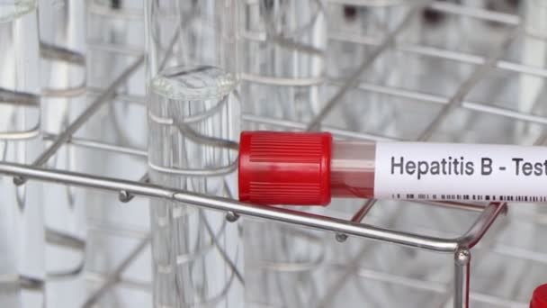 Prueba Hepatitis Para Buscar Anomalías Sangre Muestra Sangre Para Analizar — Vídeo de stock