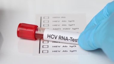 Kandaki anormallikleri araştırmak için HCV RNA Testi, laboratuvarda analiz etmek için kan örneği, test tüpünde kan
