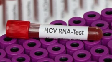 Kandaki anormallikleri araştırmak için HCV RNA Testi, laboratuvarda analiz etmek için kan örneği, test tüpünde kan