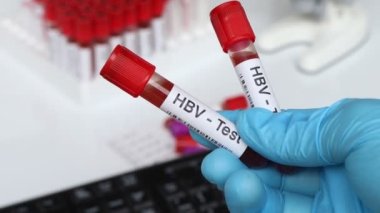 Kandaki anormallikleri araştırmak için HBV testi, laboratuvarda analiz edilecek kan örneği, test tüpündeki kan.