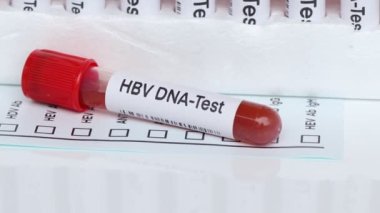 Kandaki anormallikleri araştırmak için HBV DNA testi laboratuvarda analiz etmek için kan örneği, test tüpünde kan.