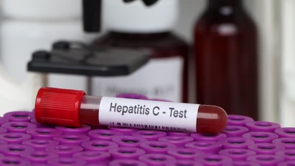 Kandaki Anormallikleri Bulmak Için Hepatit Testi Laboratuvarda Analiz Etmek Için — Stok video