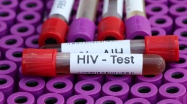 Kandaki anormallikleri araştırmak için HIV testi laboratuvarda analiz edilecek kan örneği, test tüpünde kan.