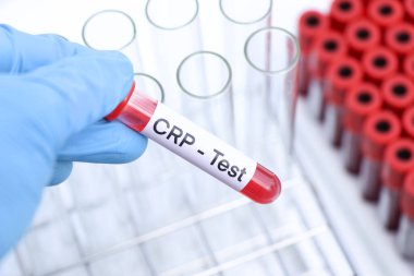 Kan anormallikleri için CRP testi, laboratuvarda analiz edilecek kan örneği, test tüpünde kan.