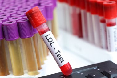 Kanda anormallikler var mı diye LDL testi laboratuvarda analiz edilecek kan örneği, test tüpünde kan.