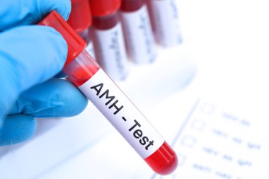 Kanda anormallik olup olmadığına bakmak için AMH testi laboratuvarda analiz edilecek kan örneği, test tüpünde kan.
