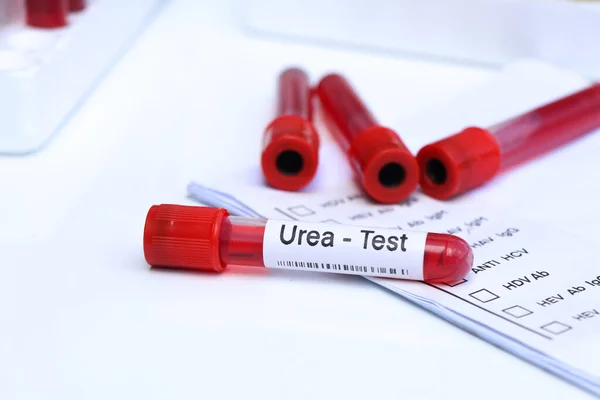 Examen Urea Para Buscar Anormalidades Sangre Muestra Sangre Para Analizar — Foto de Stock