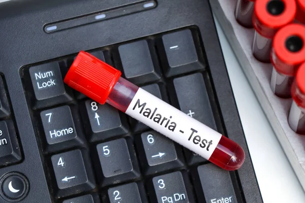 Examen Malaria Para Buscar Anomalías Sangre Muestra Sangre Para Analizar — Foto de Stock
