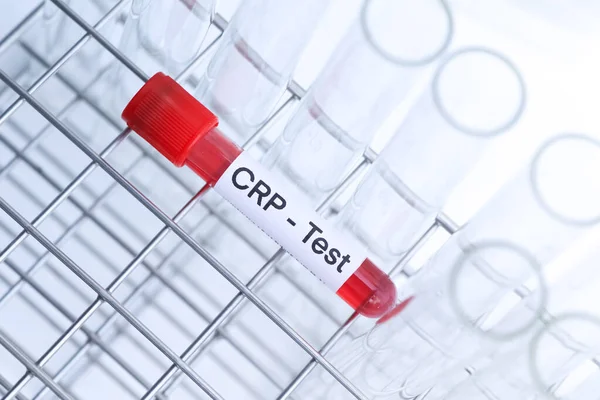 Тест Crp Наличие Отклонений Крови Образец Крови Анализа Лаборатории Кровь — стоковое фото