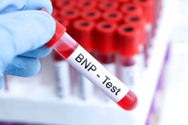 Prueba Bnp Para Buscar Anormalidades Sangre Muestra Sangre Para Analizar — Foto de Stock