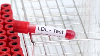 Kanda anormallikler var mı diye LDL testi laboratuvarda analiz edilecek kan örneği, test tüpünde kan.