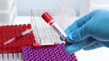 Hepatit. Kandaki anormallikleri bulmak için bir test. Laboratuvarda analiz edilecek kan örneği, test tüpünde kan.