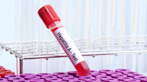 A型肝炎检查检查血液中的异常情况 血样在实验室分析 血液在试管中 — 图库视频影像