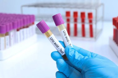 İdrar tahlilinde anormallik var mı diye ürik asit testi laboratuvarda idrar örneği, test tüpünde idrar örneği.