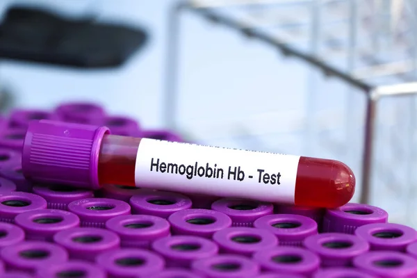 Prueba Hemoglobina Para Buscar Anomalías Sangre Muestra Sangre Para Analizar — Foto de Stock