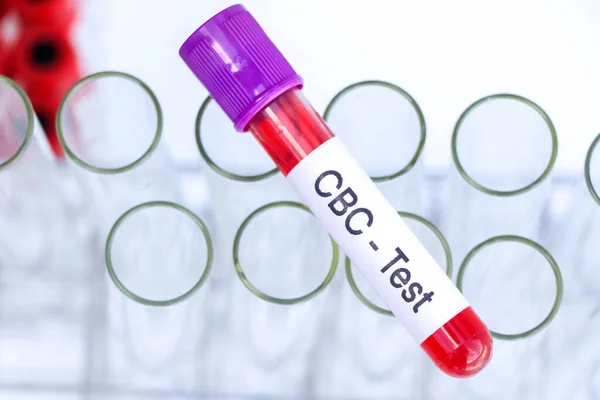 stock image CBC test to look for abnormalities from blood,  blood sample to analyze in the laboratory, blood in test tube