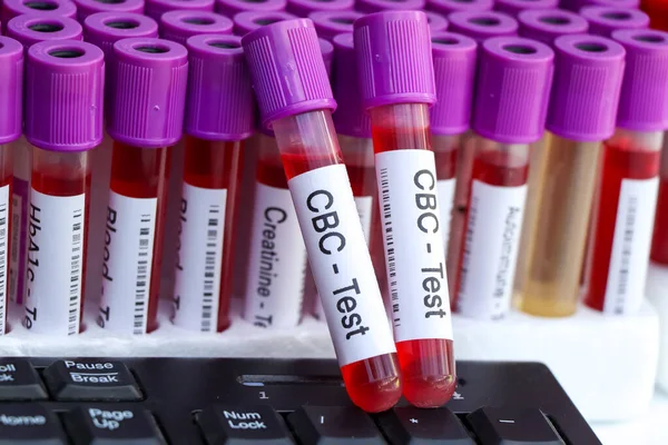Prueba Cbc Para Buscar Anormalidades Sangre Muestra Sangre Para Analizar — Foto de Stock