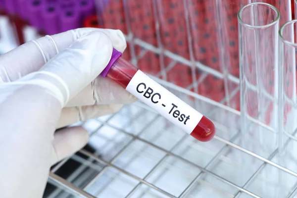 Prueba Cbc Para Buscar Anormalidades Sangre Muestra Sangre Para Analizar — Foto de Stock