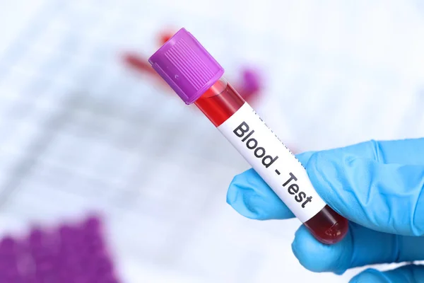 Análisis Sangre Para Buscar Anomalías Sangre Muestra Sangre Para Analizar — Foto de Stock