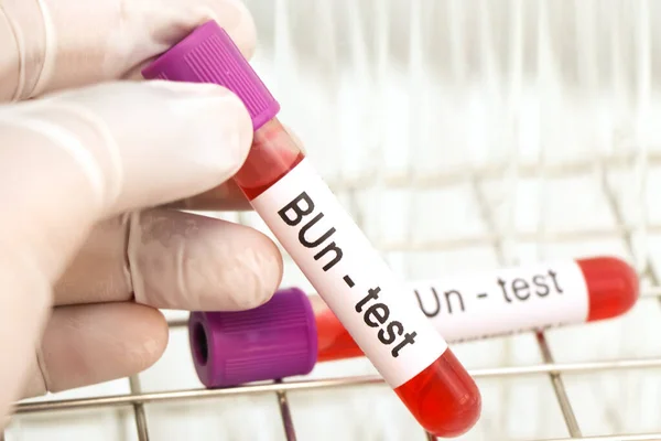 Bun Test Blood Blood Samples Analyzed Laboratory Red Blood Test — Foto de Stock