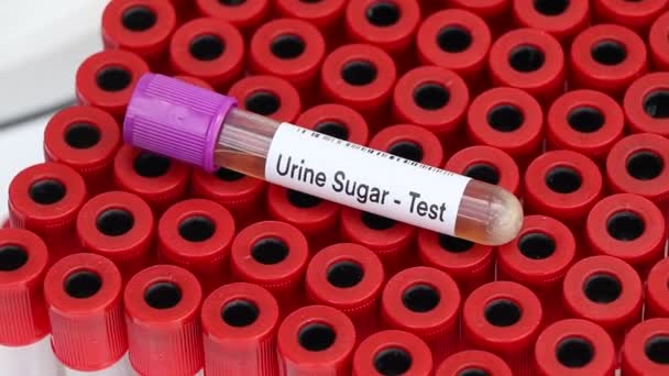 Urinzuckertest Auf Auffälligkeiten Urin Urinprobe Zur Analyse Labor Urin Reagenzglas — Stockvideo
