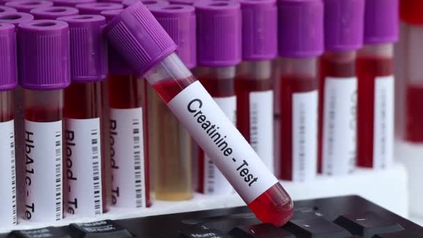 Teste Creatinina Para Procurar Anormalidades Sangue Amostra Sangue Para Analisar — Vídeo de Stock