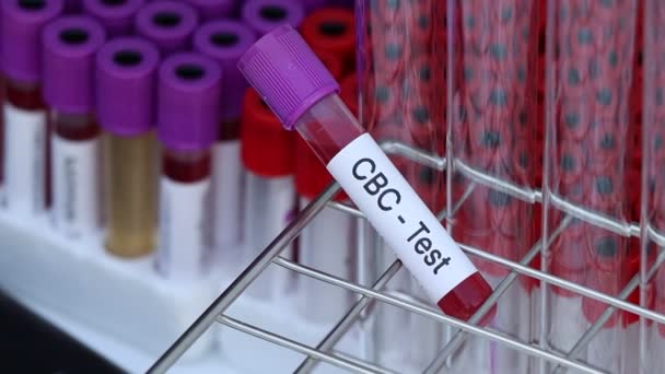 Test Cbc Cercare Anomalie Dal Sangue Campione Sangue Analizzare Laboratorio — Video Stock