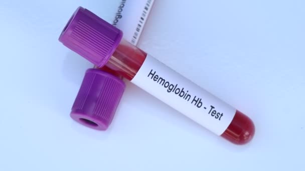 Prueba Hemoglobina Para Buscar Anomalías Sangre Muestra Sangre Para Analizar — Vídeo de stock