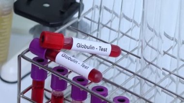 Kan anormallikleri için Globulin testi laboratuvarda analiz edilecek kan örneği, test tüpünde kan.
