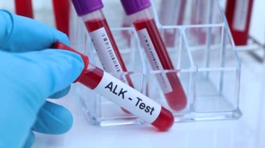 Kanda anormallikler var mı diye ALK testi laboratuvarda analiz edilecek kan örneği, test tüpünde kan.