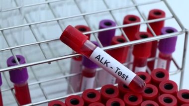Kanda anormallikler var mı diye ALK testi laboratuvarda analiz edilecek kan örneği, test tüpünde kan.