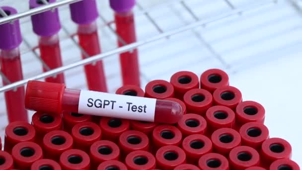 Badanie Sgpt Poszukiwaniu Nieprawidłowości Krwi Próbki Krwi Analizy Laboratorium Krew — Wideo stockowe