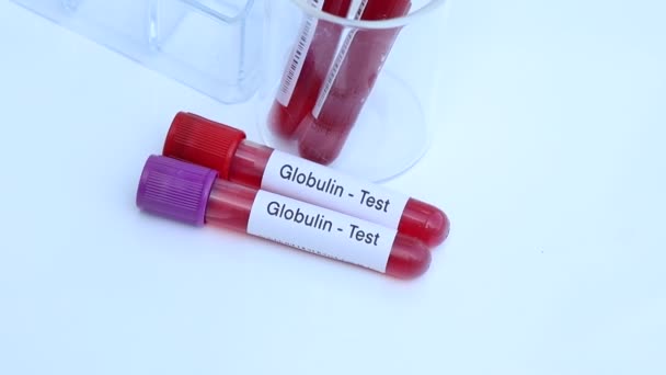 Esame Della Globulina Cercare Anomalie Dal Sangue Campione Sangue Analizzare — Video Stock