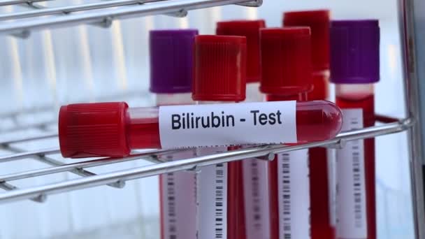 ビリルビン検査室で分析する血液サンプル検査管内の血液検査 — ストック動画